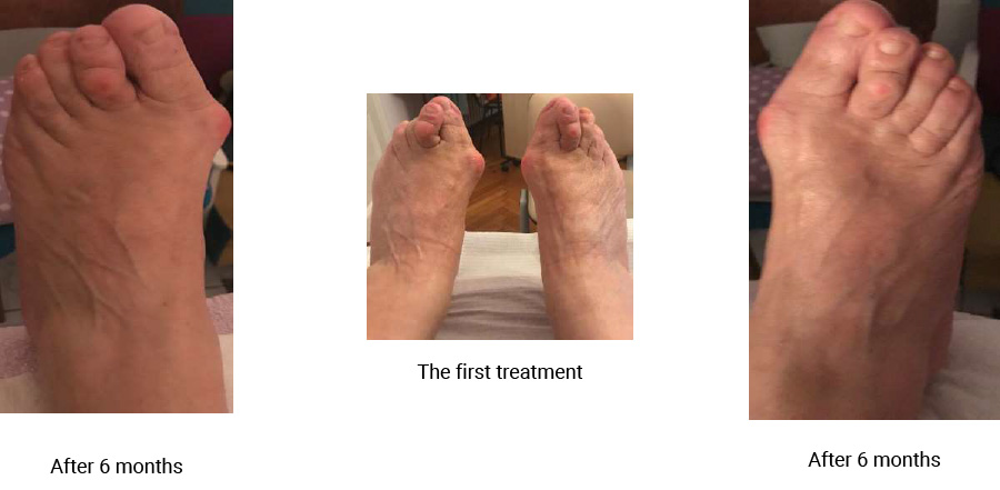 Hallux Valgus without surgery