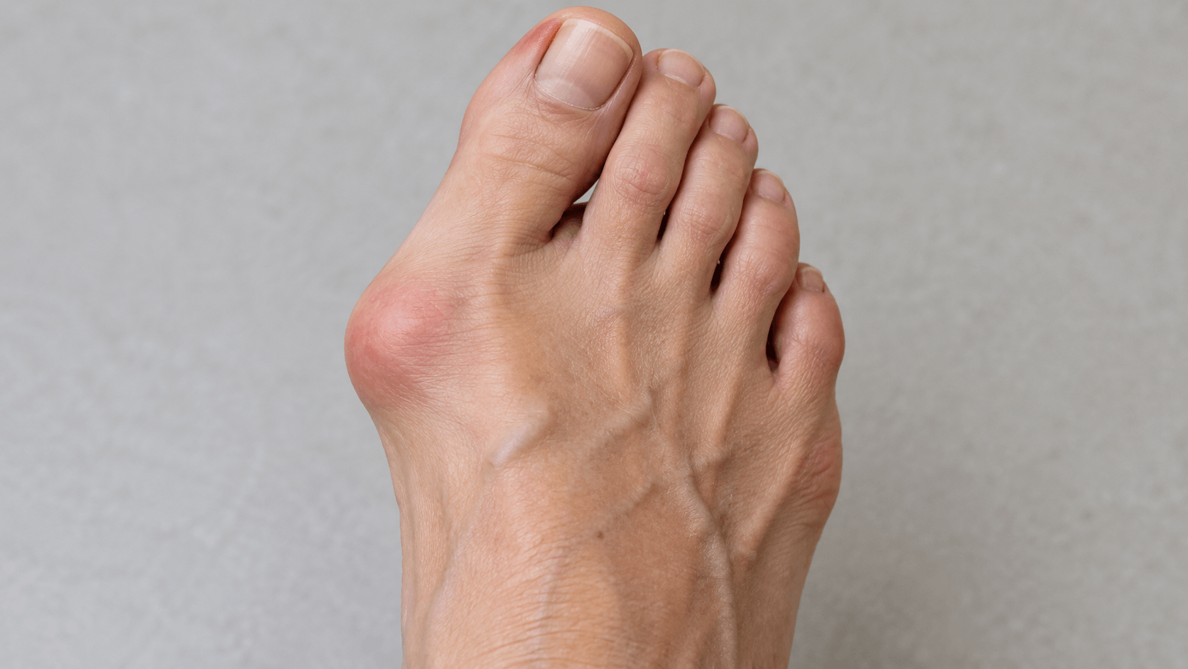 cukalj-hallux-valgus-stopalo.png